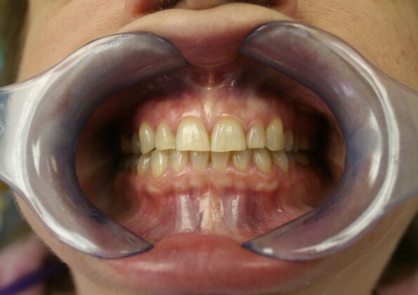 Full Mouth Reconstruction Brooklyn NY: Case 11 - Before
