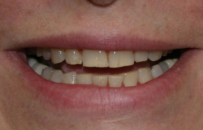 Full Mouth Reconstruction Brooklyn NY: Case 11 - Before