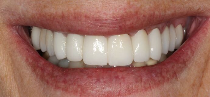 Full Mouth Reconstruction Brooklyn NY Case 12 - After