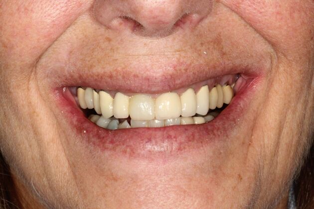 Full Mouth Reconstruction Brooklyn NY Case 12 - Before