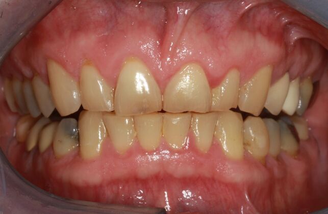 Smile Makeover Brooklyn, NY  Smile Makeover Old Tired Worn Teeth Bay Ridge, NY - Before