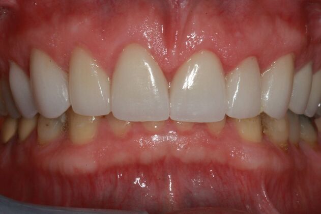 Smile Makeover Brooklyn, NY  Smile Makeover Old Tired Worn Teeth Bay Ridge, NY - After