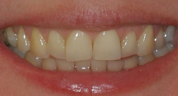 Smile Makeover Brooklyn, NY : Smile Makeover After Orthodontic Therapy Bay Ridge, NY - Before