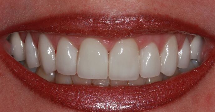 Smile Makeover Brooklyn, NY : Smile Makeover After Orthodontic Therapy Bay Ridge, NY - After