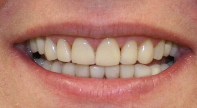 Smile Makeover Brooklyn, NY : Smile Makeover Replacing Unbecoming Restorations Bay Ridge, NY - Before