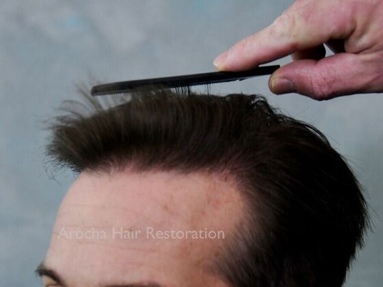 FUE Hair Restoration: Case 30 - After
