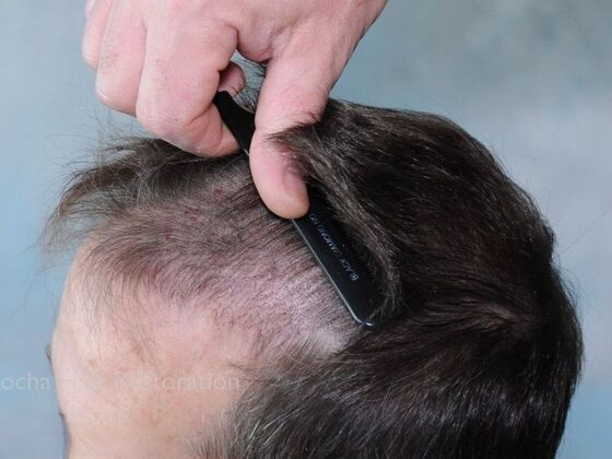 FUE Hair Restoration: Case 30 - Before