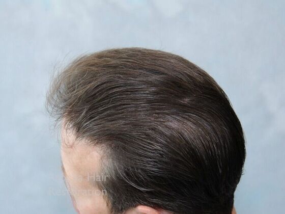 FUE Hair Restoration: Case 30 - After