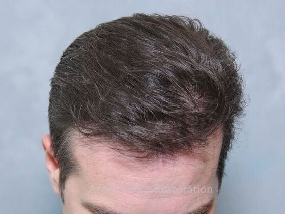 FUE Hair Restoration: Case 30 - After