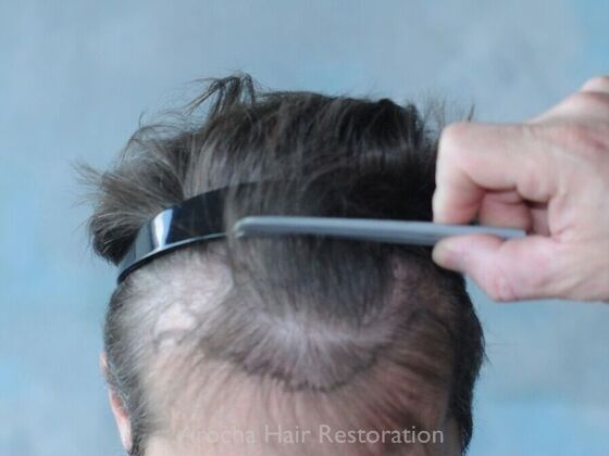 FUE Hair Restoration: Case 30 - Before