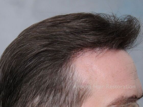 FUE Hair Restoration: Case 30 - Before