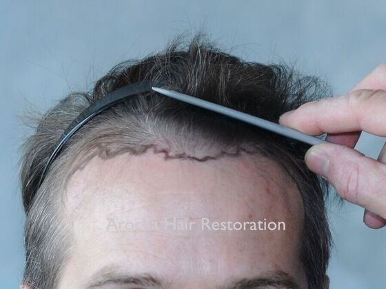 FUE Hair Restoration: Case 30 - Before