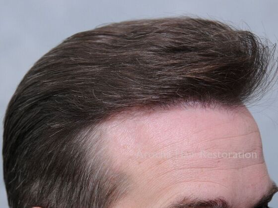 FUE Hair Restoration: Case 30 - After