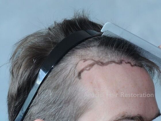 FUE Hair Restoration: Case 30 - Before