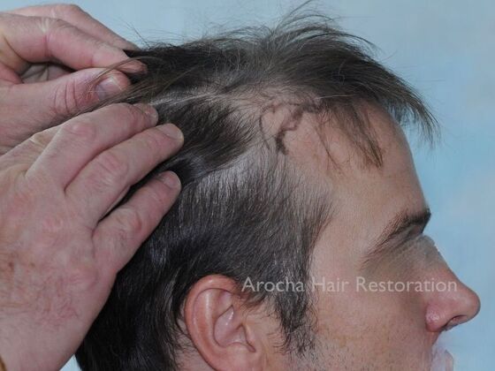 FUE Hair Restoration: Case 30 - Before