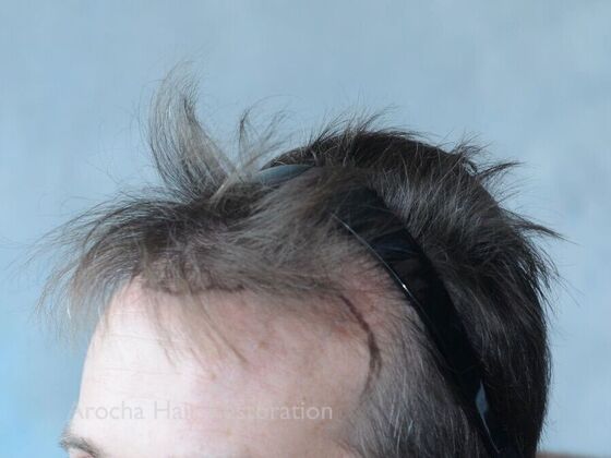 FUE Hair Restoration: Case 30 - Before