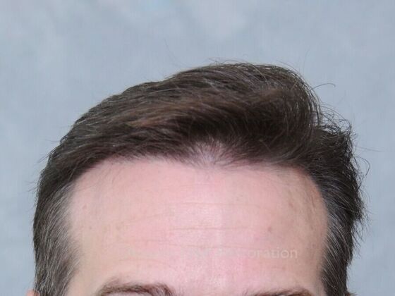 FUE Hair Restoration: Case 30 - After