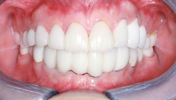 Special Implant Reconstruction Case