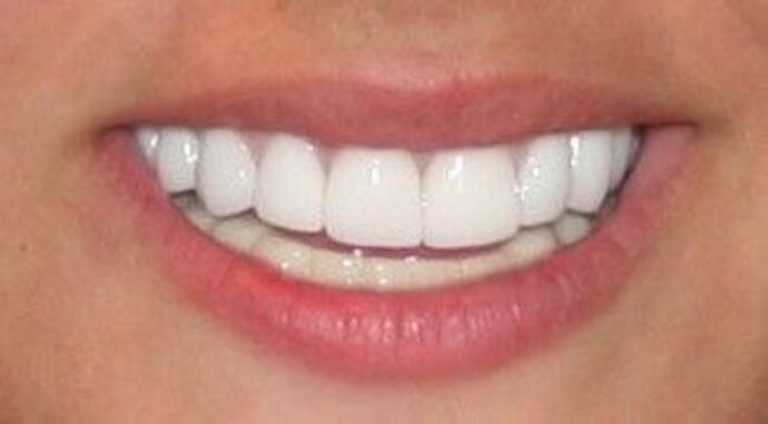 Special Implant Reconstruction: Miracle at 7424-Ridge Blvd Bay Ridge Brooklyn - After