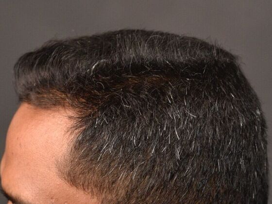 FUE Hair Restoration: Case 31 - After