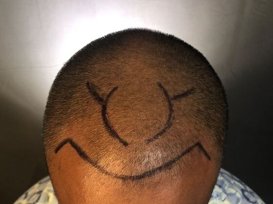 FUE Hair Restoration: Case 31 - Before