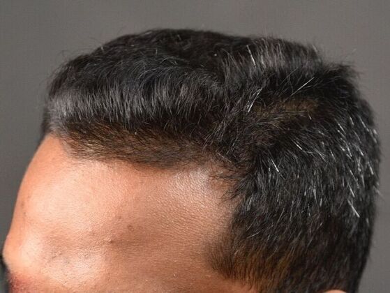 FUE Hair Restoration: Case 31 - After