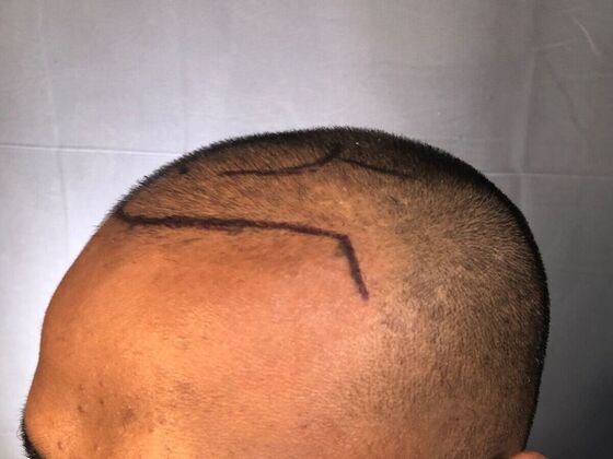 FUE Hair Restoration: Case 31 - Before
