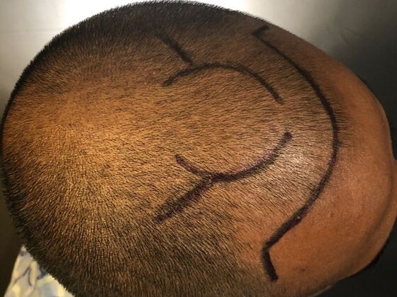 FUE Hair Restoration: Case 31 - Before