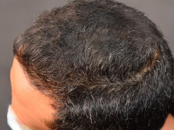 FUE Hair Restoration: Case 31 - Before