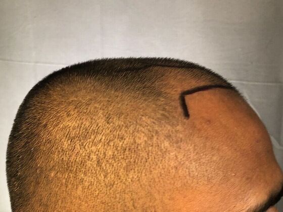 FUE Hair Restoration: Case 31 - Before