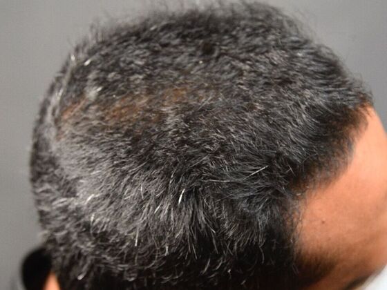 FUE Hair Restoration: Case 31 - After