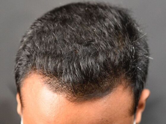 FUE Hair Restoration: Case 31 - After