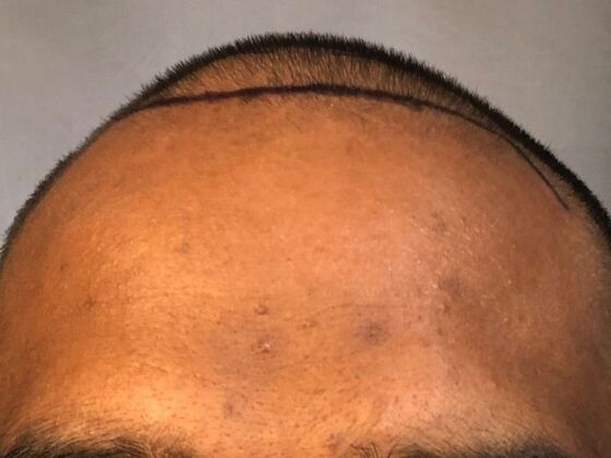 FUE Hair Restoration: Case 31 - Before