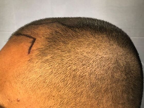 FUE Hair Restoration: Case 31 - Before