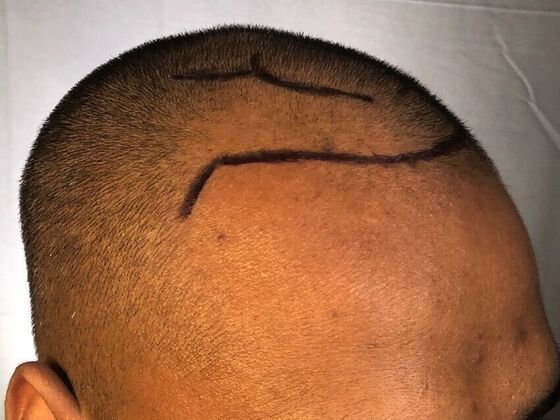 FUE Hair Restoration: Case 31 - Before