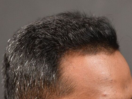 FUE Hair Restoration: Case 31 - After