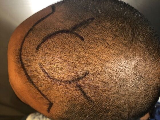 FUE Hair Restoration: Case 31 - Before