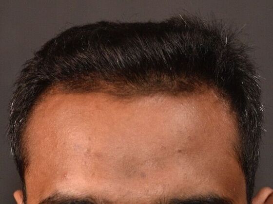 FUE Hair Restoration: Case 31 - After