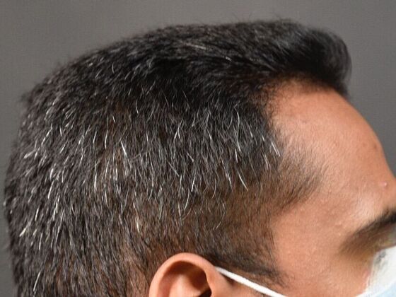 FUE Hair Restoration: Case 31 - After