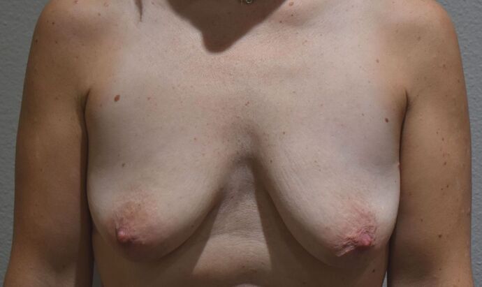 Breast Augmentation w/ Lift Case 508 - Before