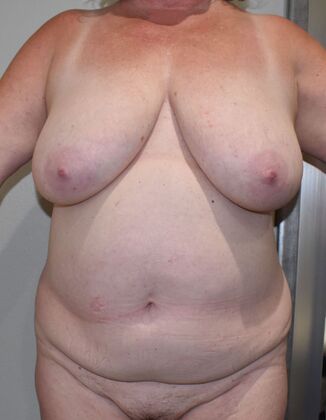 Mommy Makeover Case 286 - Before