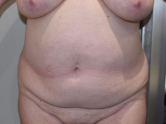 Tummy Tuck (Abdominoplasty): Case 438 - Before