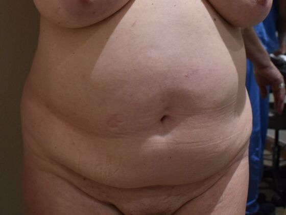 Tummy Tuck (Abdominoplasty): Case 438 - Before