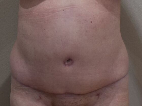 Tummy Tuck (Abdominoplasty): Case 438 - After