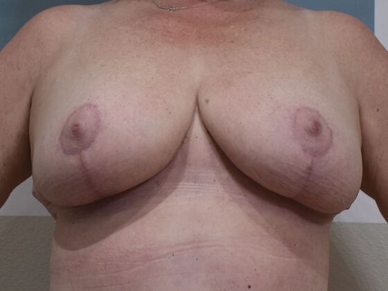 Breast Lift (Mastopexy) Case 181 - After