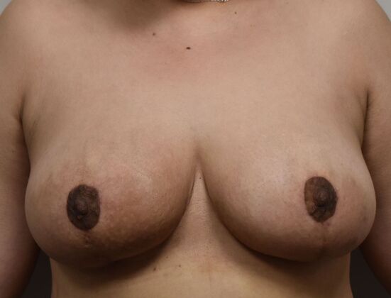 Breast Lift (Mastopexy) Case 182 - After