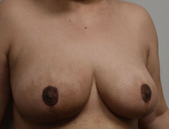 Breast Reduction: Case 167 - After