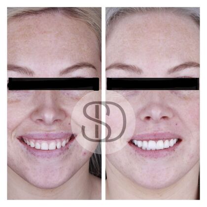 Full Mouth Restoration with Zirconia Crowns Case 1