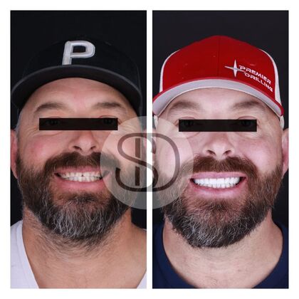 Full Mouth Restoration with Zirconia Crowns Case 4 - Before