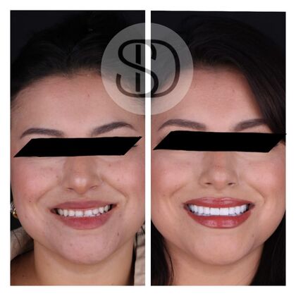 Full Mouth Restoration with Zirconia Crowns Case 5